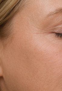 Haut nach der Behandlung mit weniger sichtbaren Pigmentflecken und Falten